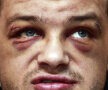 Chip de boxer
Aşa arăta JoJo Dan, adică Ionuţ Dan Ion, după meciul pierdut în faţa turcului Aydin. Tăieturi, vînătăi şi o fractură de mandibulă ce nu se vede, dar doare Foto: Alex Nicodim