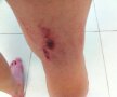 Aşa arată piciorul lui Surdu după faultul lui Dragoş Grigore