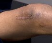 Avînd ligamentele încrucişate afectate, plus fractură de rotulă, Bratu a suferit o intervenţie chirurgicală complicată, care şi-a lăsat o amprentă urîtă pe piciorul fotbalistului // Foto: Raed Krishan (Achenkirch, Austria)