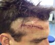 FOTO 13 puncte de sutură! » Christoph Moritz, mijlocaşul lui Mainz, a avut fruntea tăiată de crampoanele adversarului