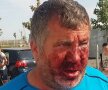 FOTO EXCLUSIV Cum arată antrenorul bătut de 8 persoane la un meci din Giurgiu: "Nu se poate bărbieri, e vânăt tot de la piept în sus"