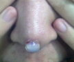 Fotografii șocante. Uite cum arată nasul unei femei după o operație nereușită!