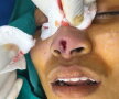 Fotografii șocante. Uite cum arată nasul unei femei după o operație nereușită!