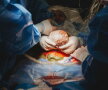 GALERIE FOTO O femeie și-a scos singură copilul din pântece, în timpul operației de cezariană
