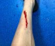 FOTO Cum arată piciorul lui Ianis după intrarea criminală a lui Mihăescu! Ce s-a întâmplat după meci, la vestiare