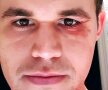 "Se complică lucrurile" în finala CM de șah! Magnus Carlsen, deținătorul en-titre al titlului, s-a ales cu o rană la ochi după ce s-a izbit într-un jurnalist norvegian, conform The Guardian // foto: Instagram