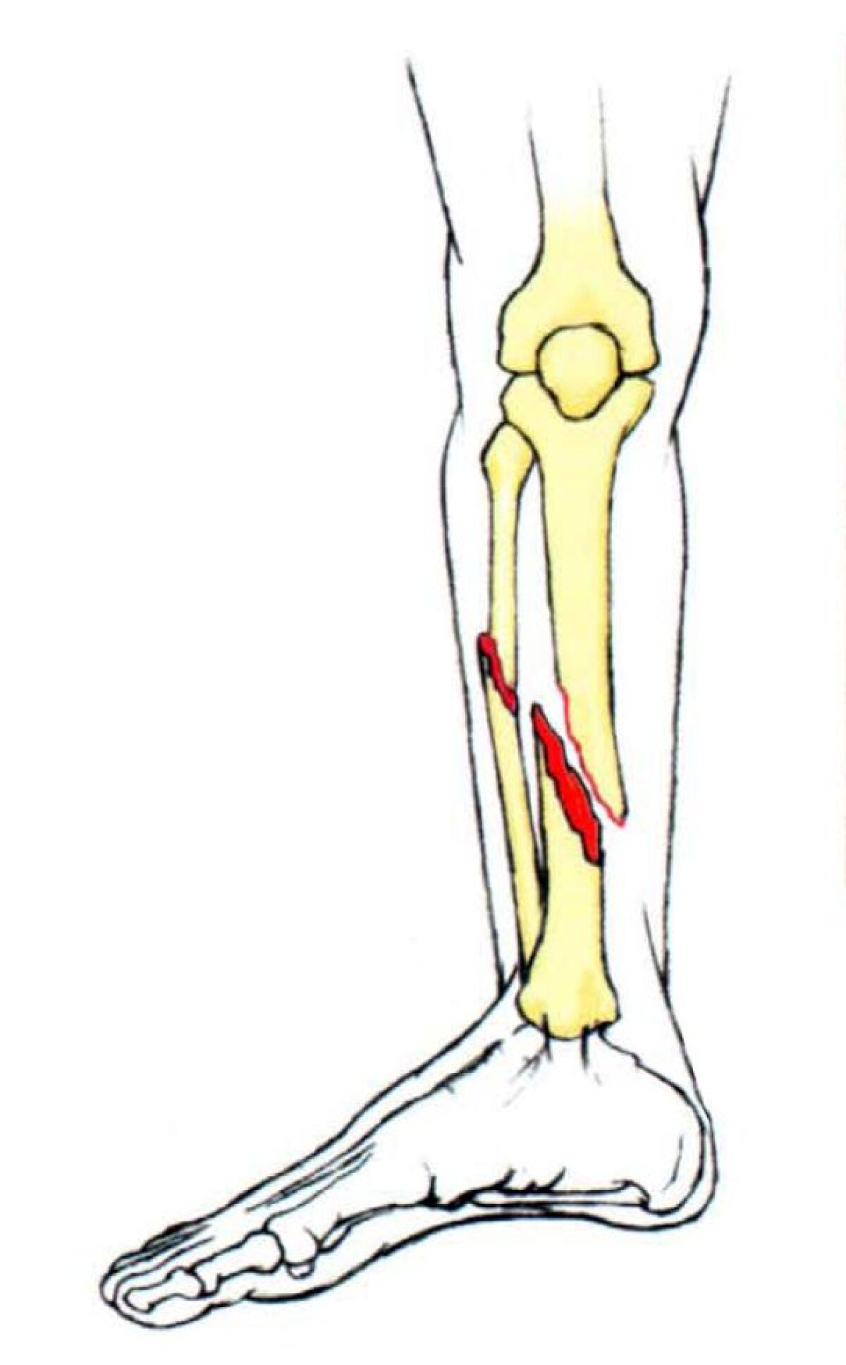 Medicii de la Elias anunţă că operaţia lui Băcilă a fost un succes. Poate reveni pe teren în martie