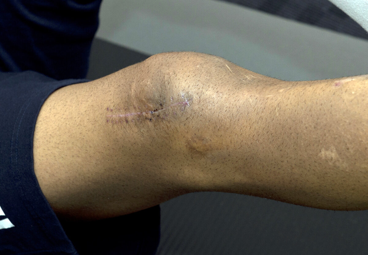 EXCLUSIV GSP Cum se reface o rotulă » Gazeta a asistat la o şedinţă de recuperare a lui Doru Bratu