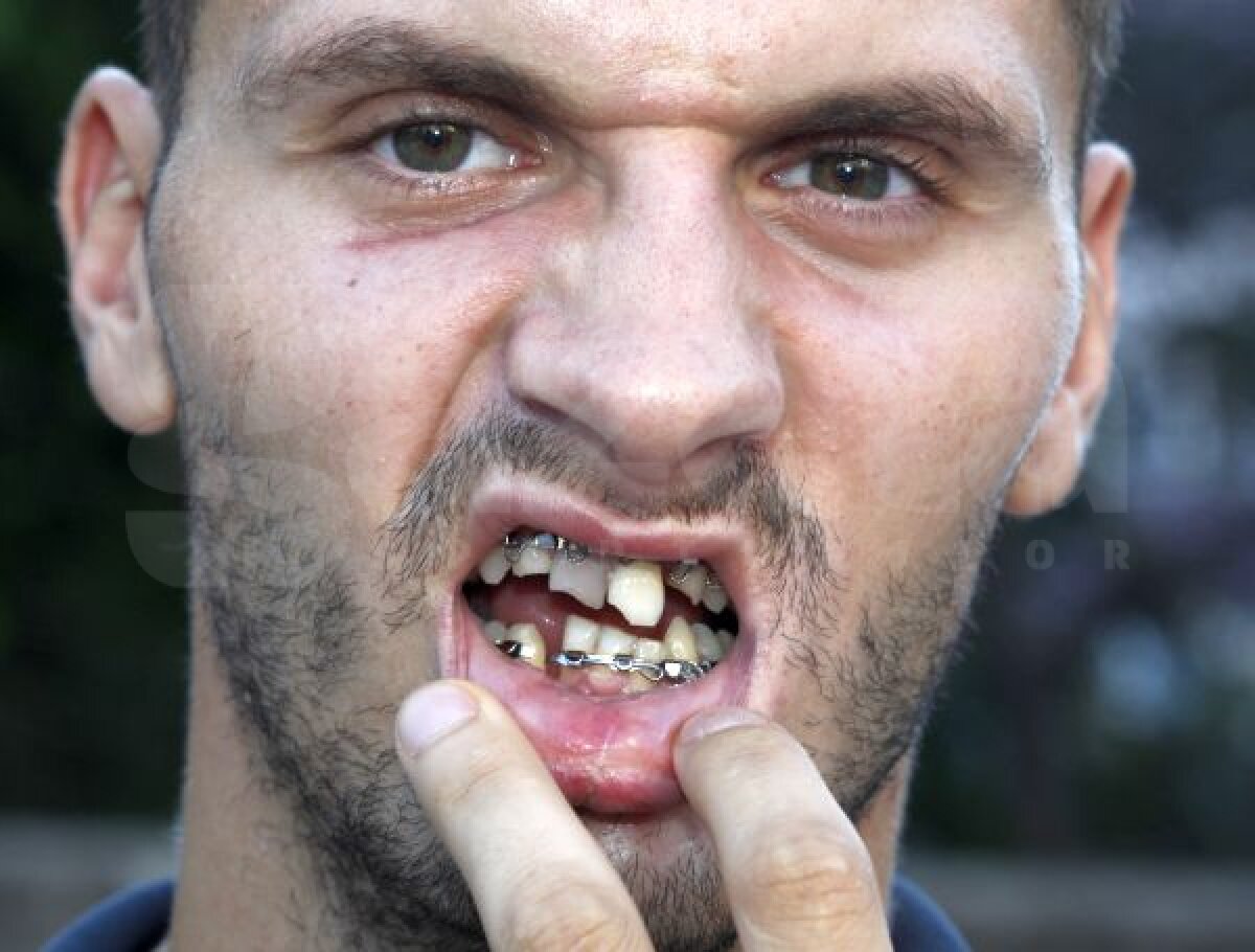 FOTO Şocant! Zîmbetul stîlcit de fiare » Aşa arată kaiacistul Iustin Porcăraşu, la o lună de la accident
