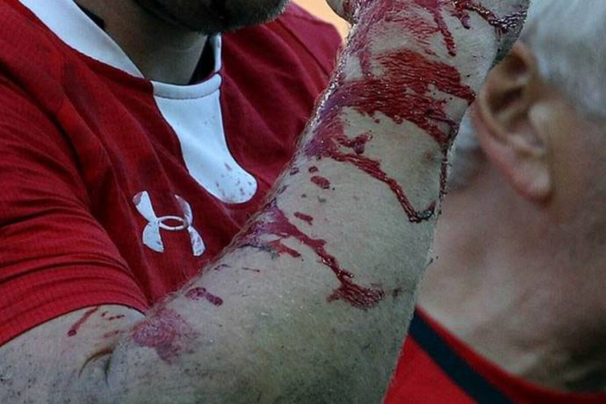 FOTO Fotbalul întunecat de două accidentări-horror! » Picior rupt ca un vreasc