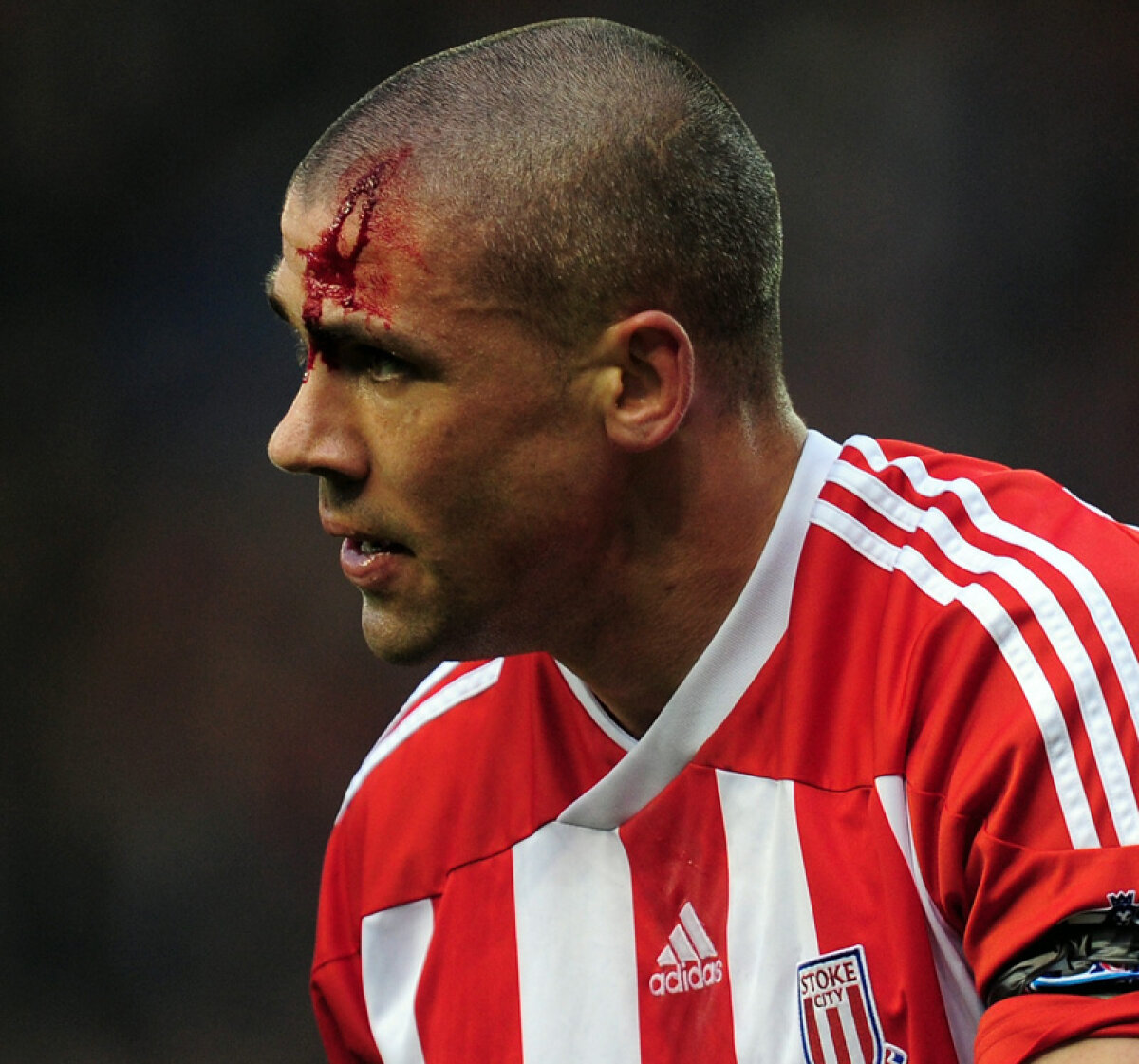 Survivor » Jon Walters, omul care joacă pentru Stoke cu capul spart. De două ori într-un an!