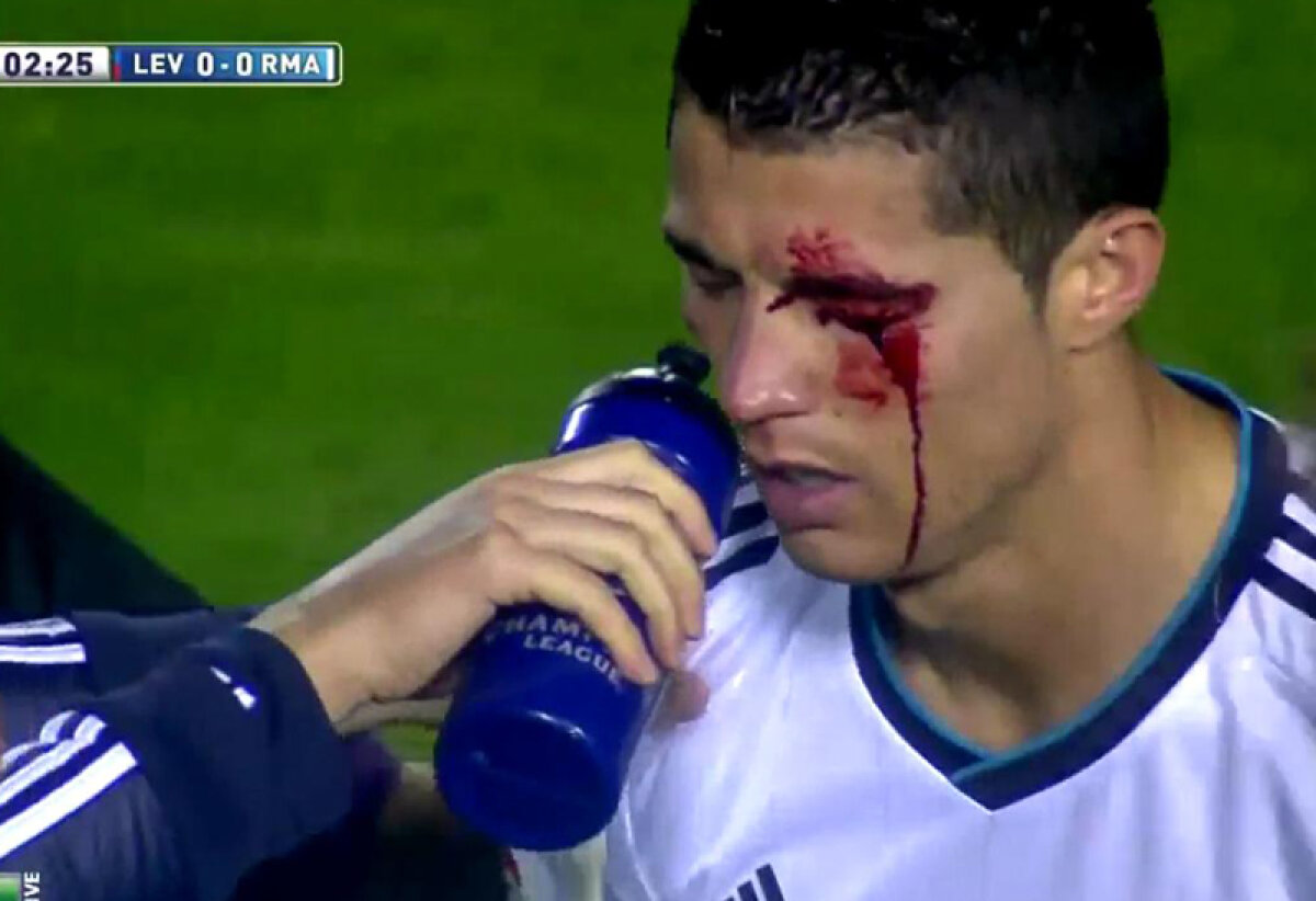 FOTO&VIDEO Ronaldo, eroul lui Real » I s-a spart arcada, a fost cusut pe teren şi a marcat deşi avea dureri mari de cap!