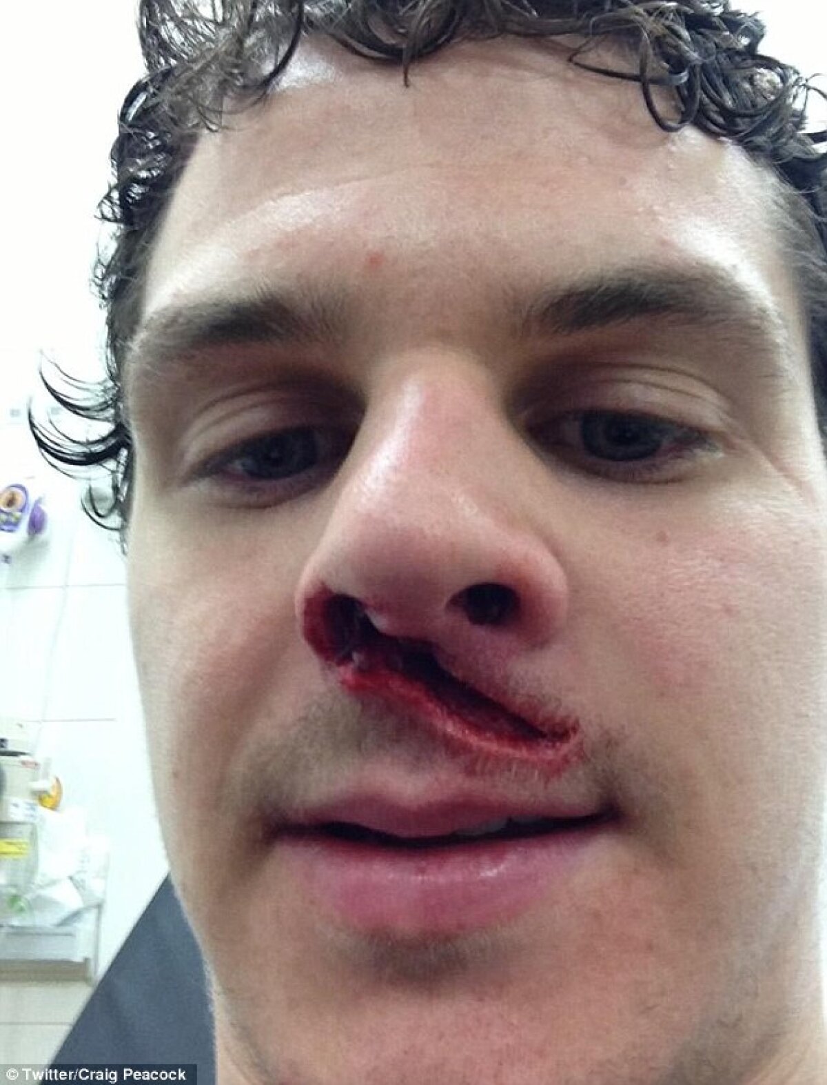 29 de copci! » Accidentare urîtă pentru un jucător de hochei: atenţie, imagini terifiante!