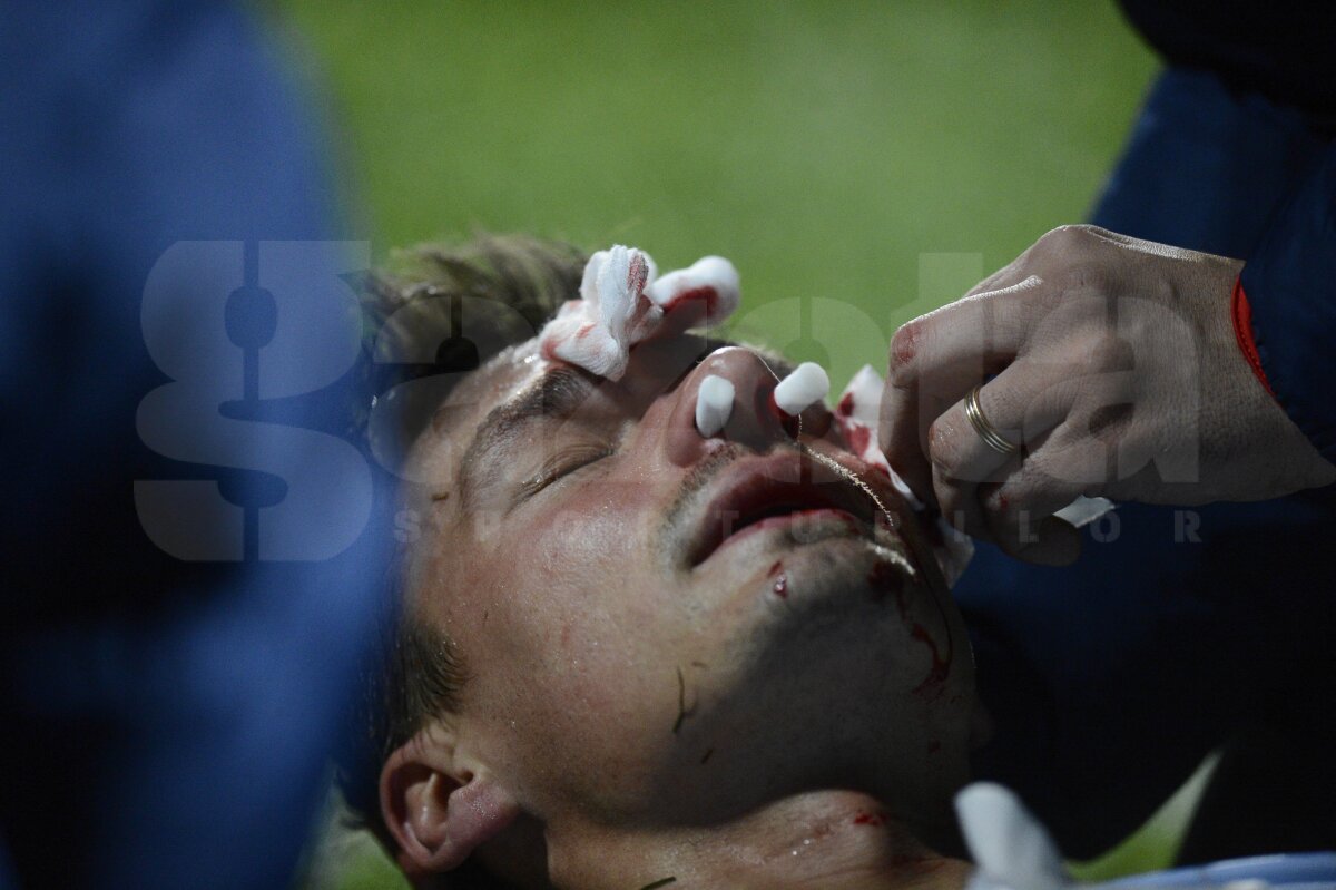 UPDATE Szukala are fractură de piramidă nazală şi ar putea rata "dubla" cu Ajax