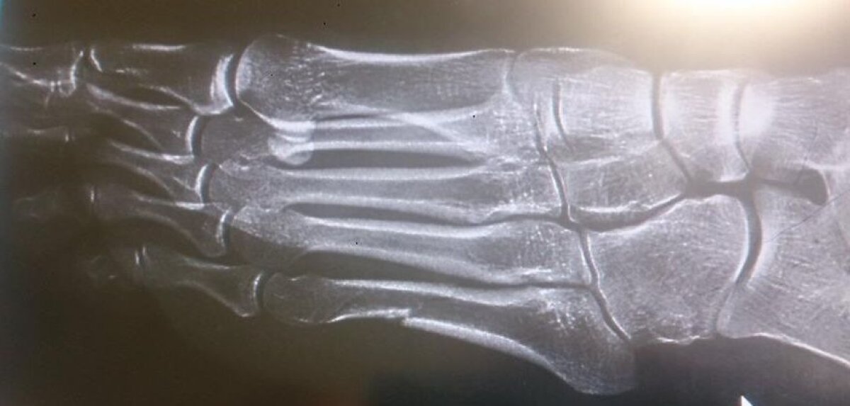 Aur cu piciorul rupt » Justyna Kowalczyk a cucerit al doilea titlu olimpic al carierei