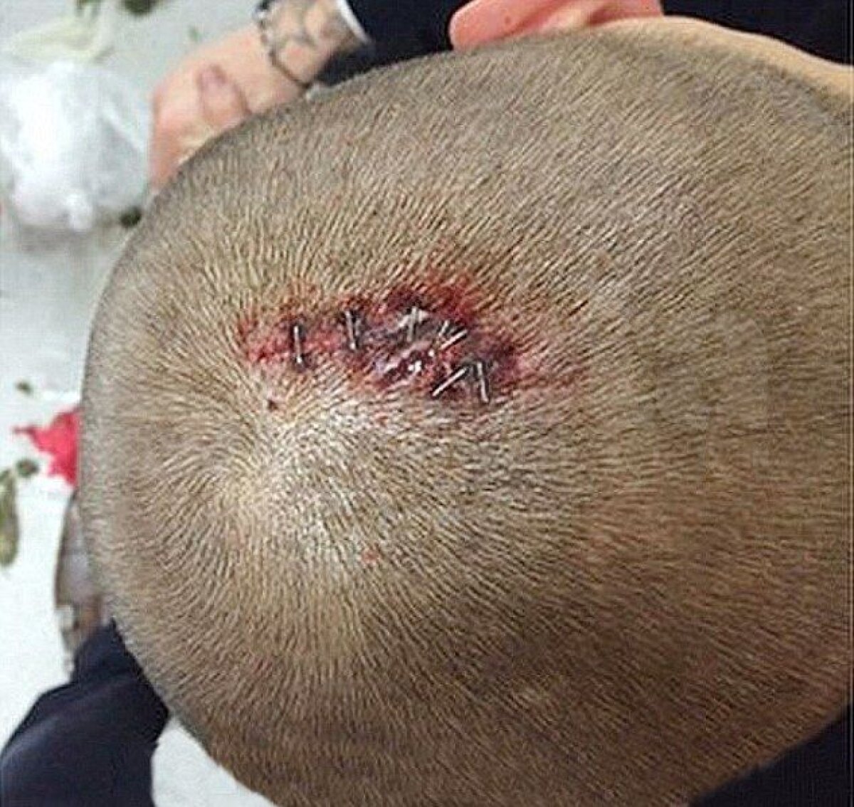 FOTO Week-end însîngerat în Premier League » Trei fotbalişti s-au lovit urît în ultima etapă