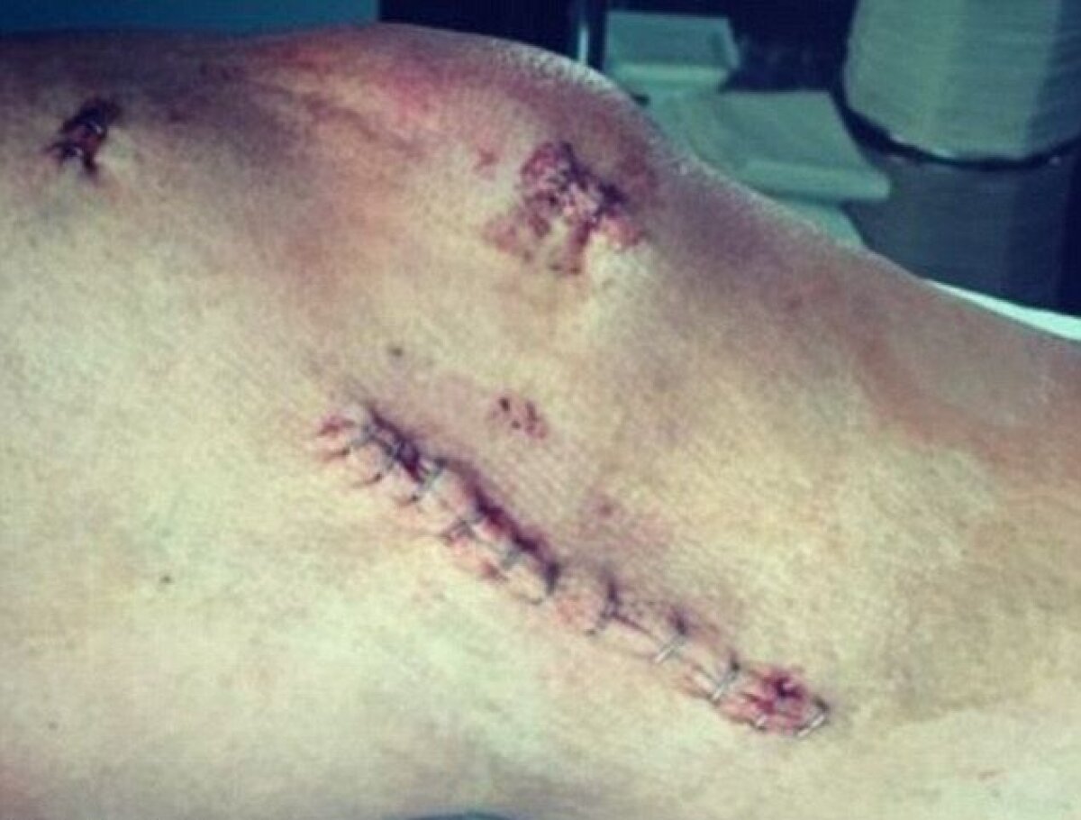 FOTO Imagini terifiante cu genunchiul unui jucător pe care Liverpool a dat 40 de milioane de euro