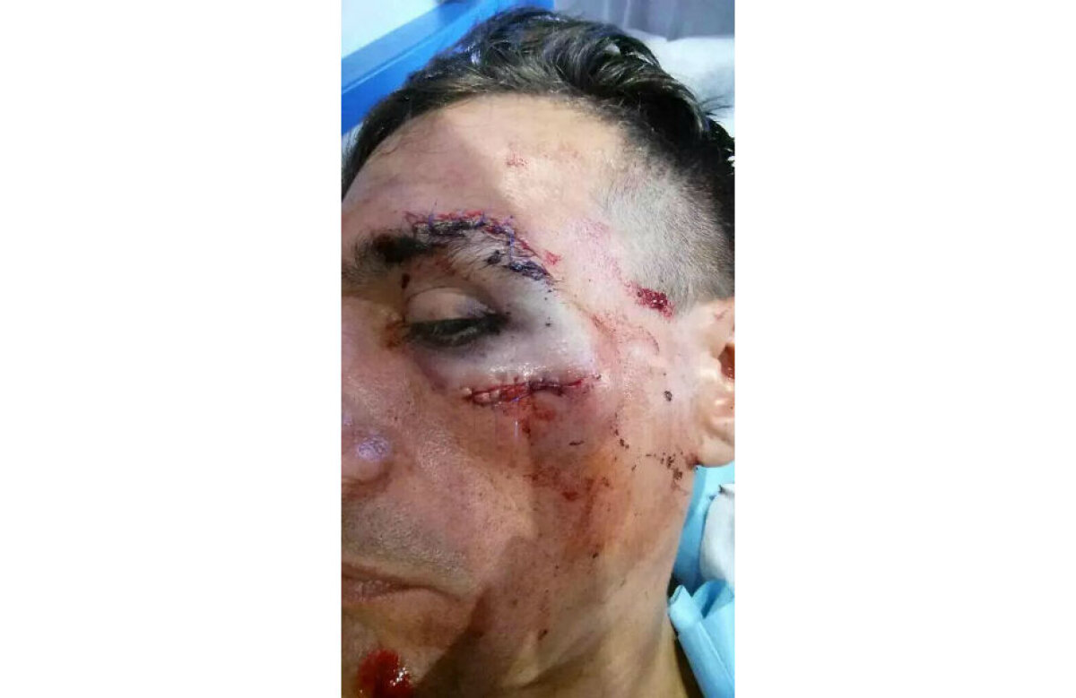 Imagini horror din Turul Spaniei » Abandon + 40 de puncte de sutură