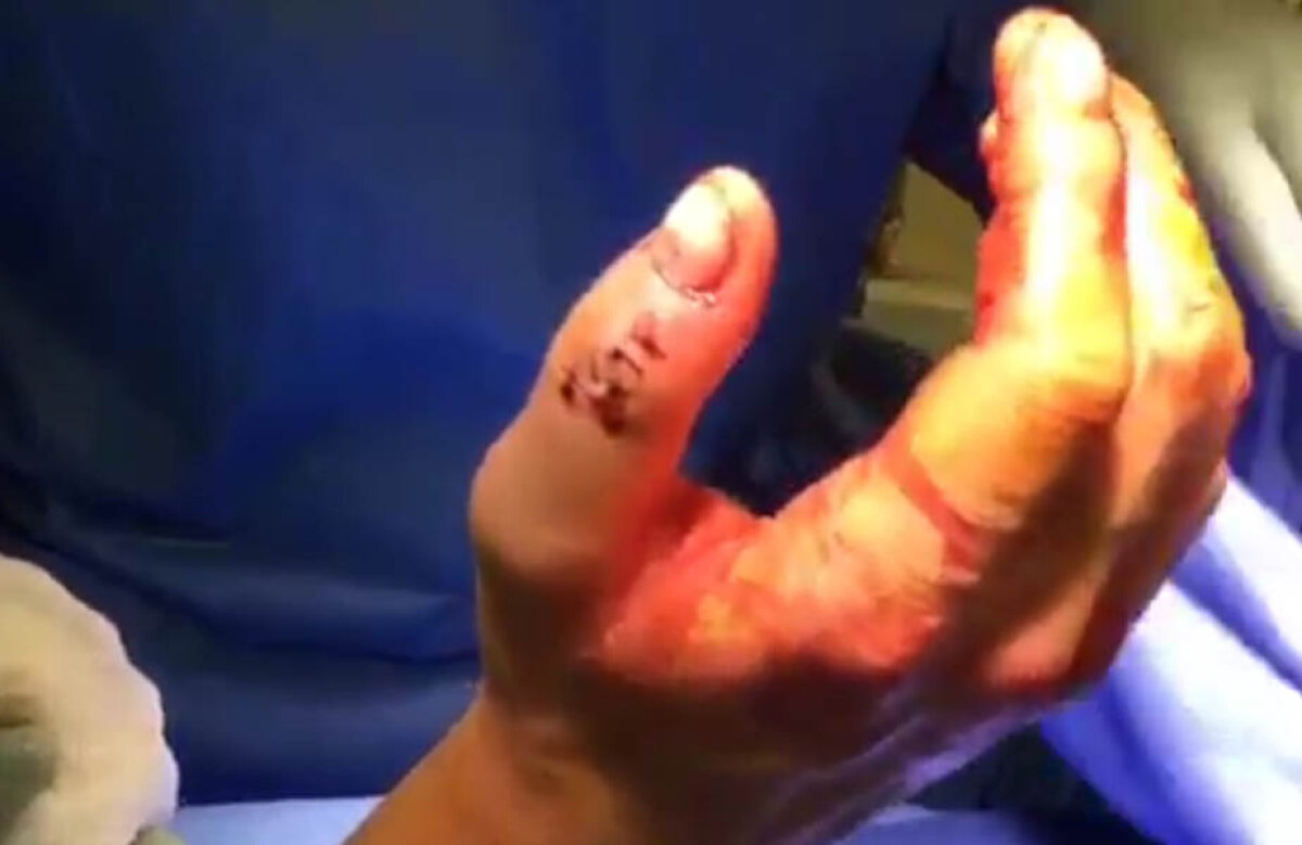 Lindsey Vonn e lipsită de noroc! A fost mușcată de un cîine » Fotografie înfiorătoare de pe patul de spital