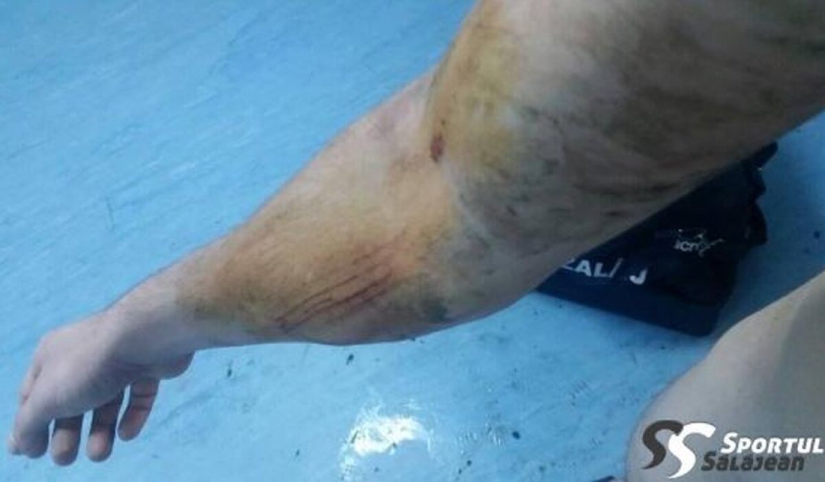 FOTO Atenție, imagini dure! Accidentare groaznică în fotbalul românesc » Cum arată antebrațul unui portar după ce a fost călcat cu crampoanele