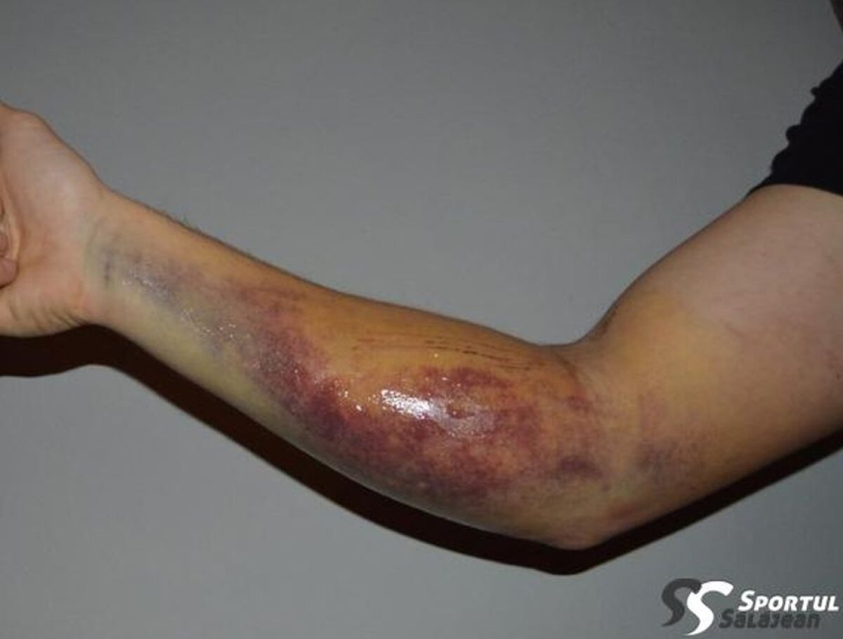FOTO Atenție, imagini dure! Accidentare groaznică în fotbalul românesc » Cum arată antebrațul unui portar după ce a fost călcat cu crampoanele