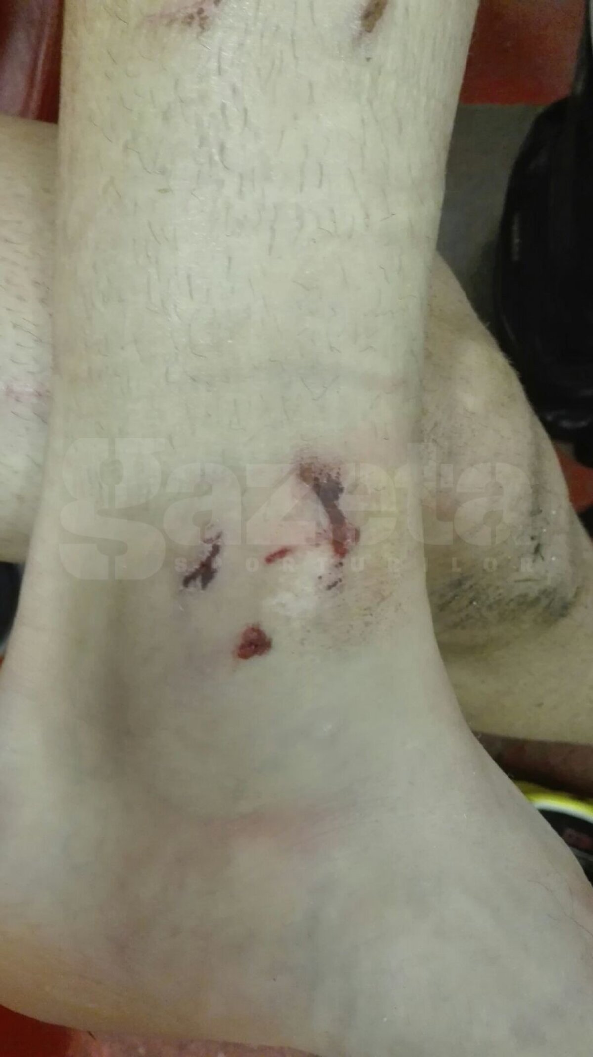 EXCLUSIV FOTO Imaginea șocantă cu glezna unui dinamovist după meciul cu Steaua » Bourceanu făcut praf