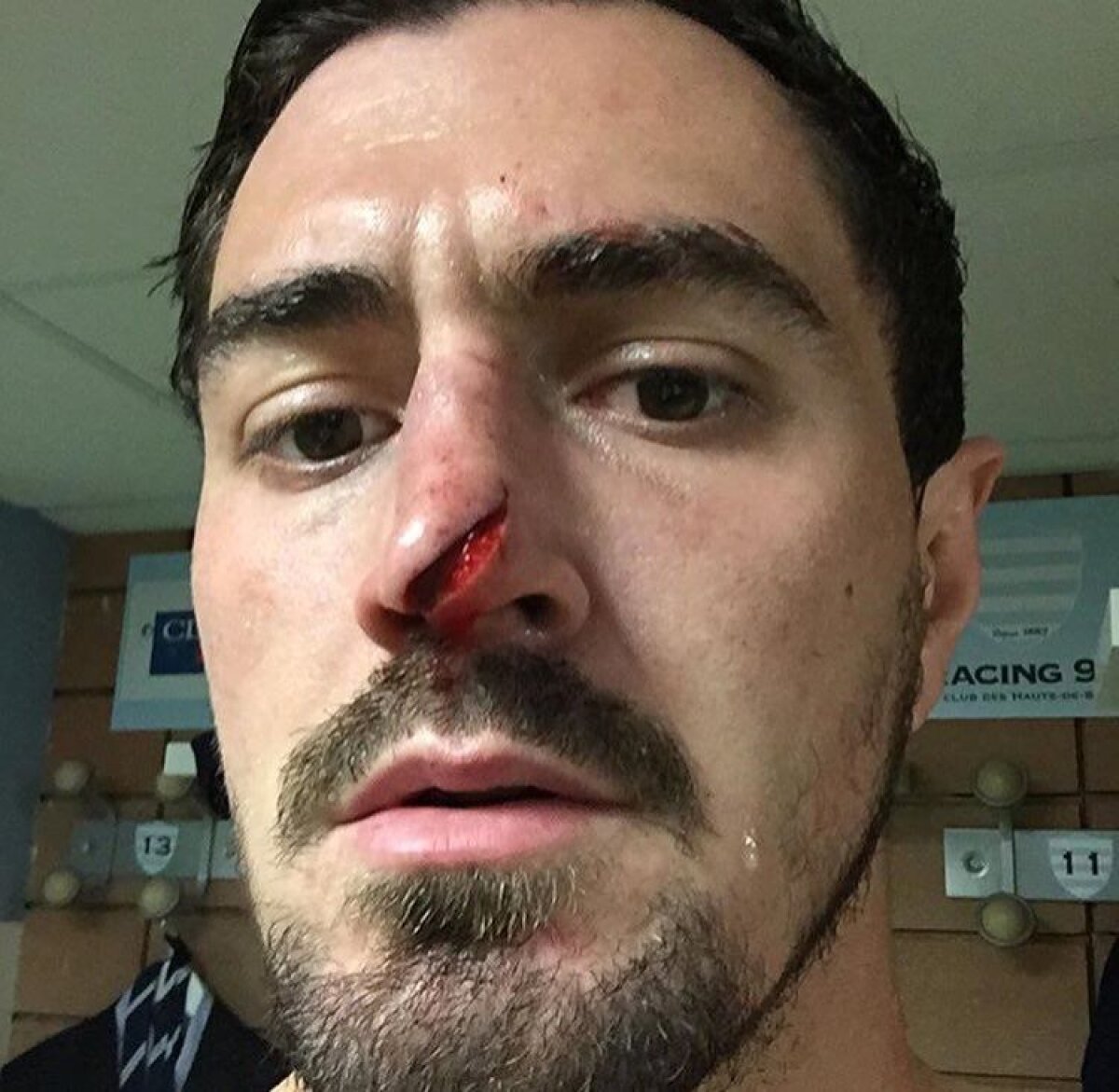 Atenție, imagine ȘOCANTĂ! » I-au tăiat nasul cu crampoanele » FOTO la interior