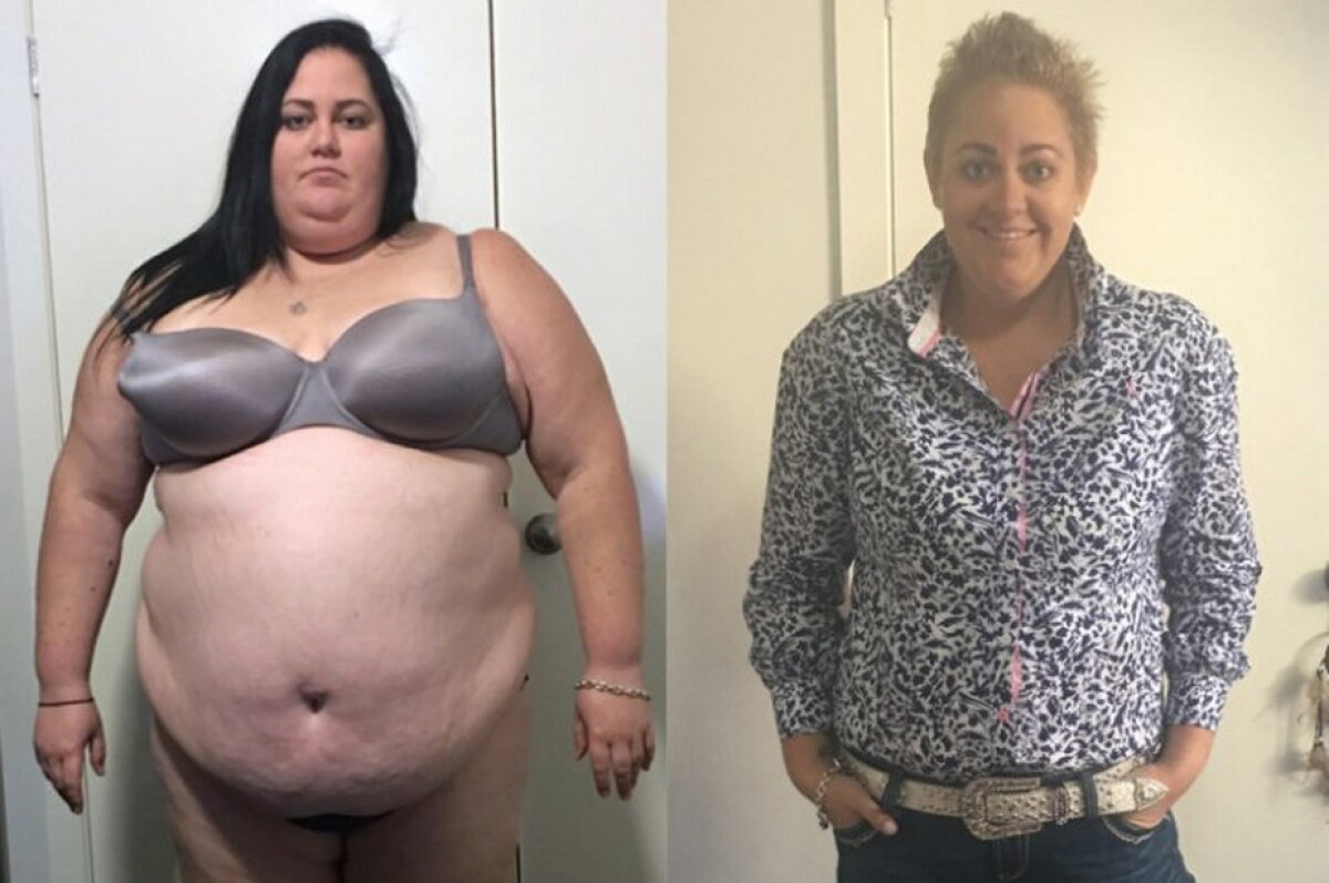 O femeie de 28 de ani avea 170 de kilograme. Ce a urmat a uimit întreaga lume