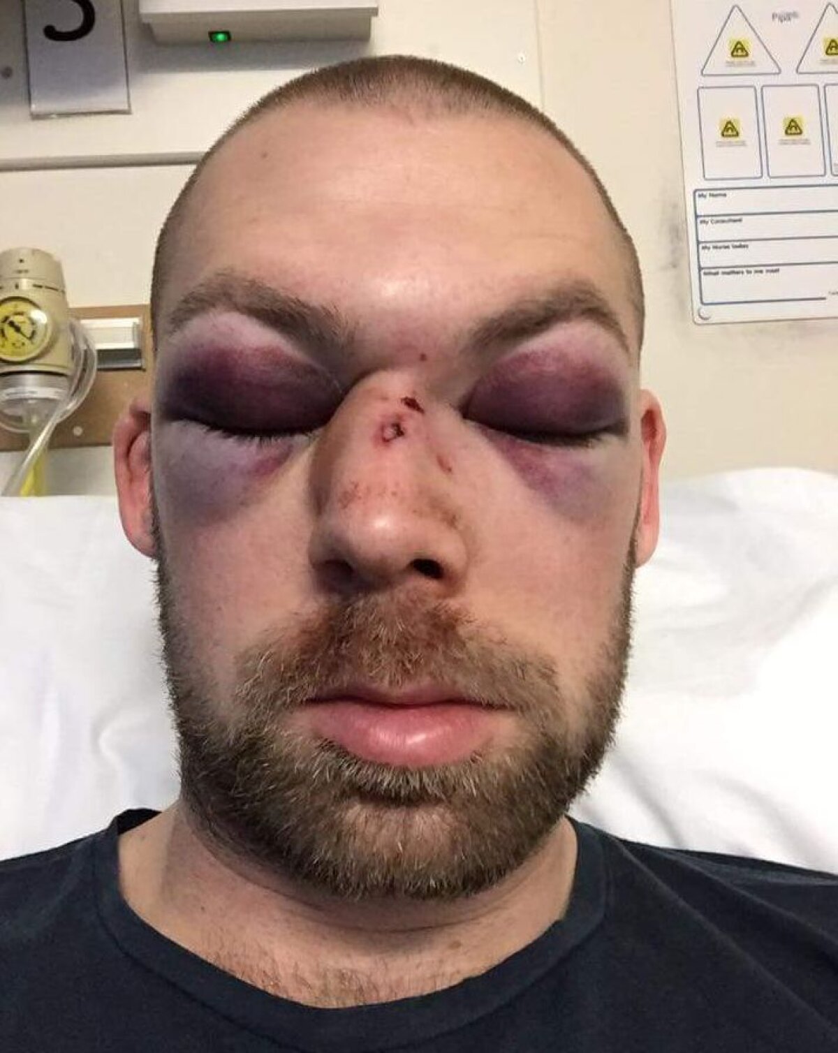 FOTO Jucător lovit în cap cu o minge, a suferit 15 fracturi! Atenție, imagini HORROR