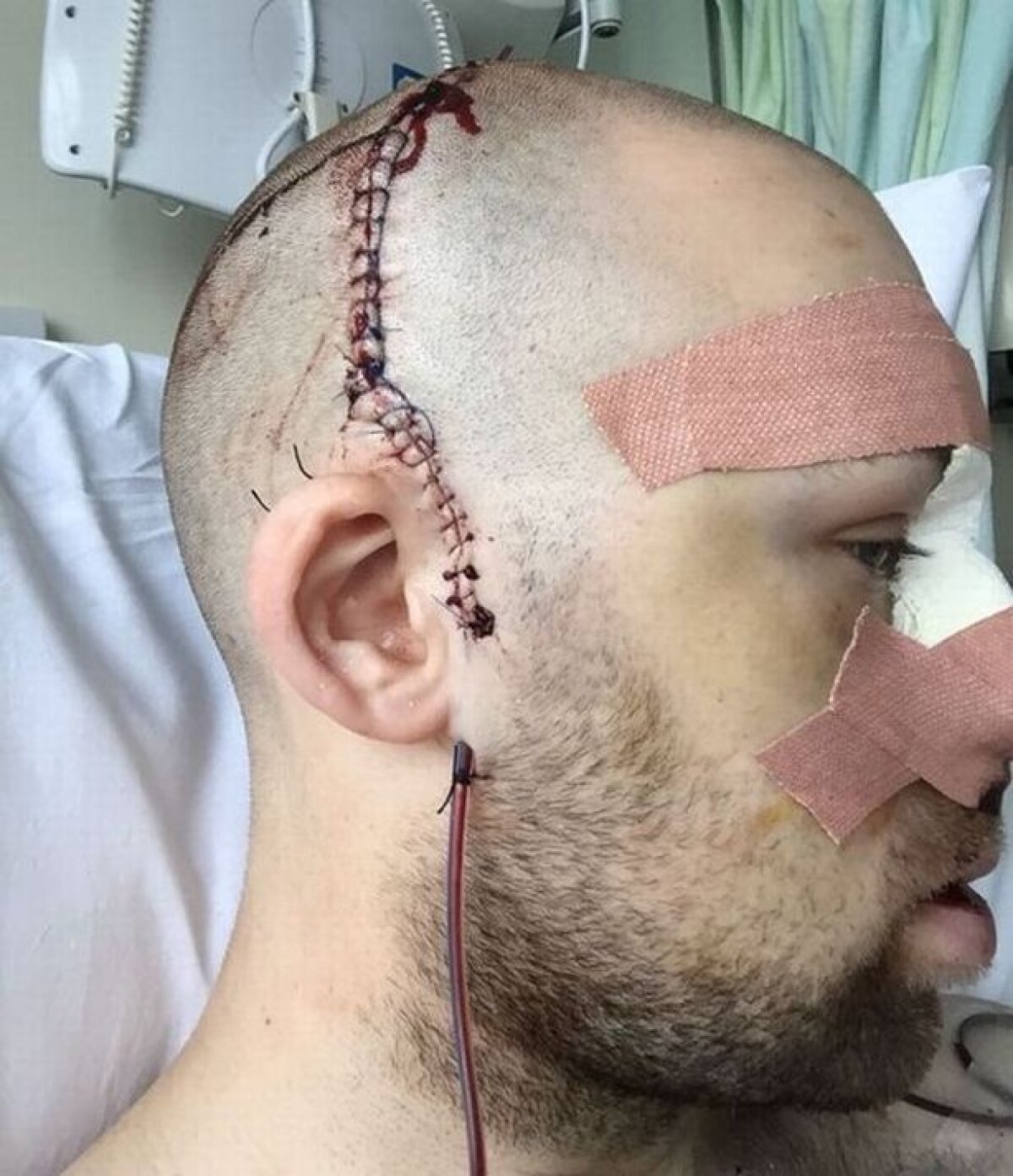 FOTO Jucător lovit în cap cu o minge, a suferit 15 fracturi! Atenție, imagini HORROR