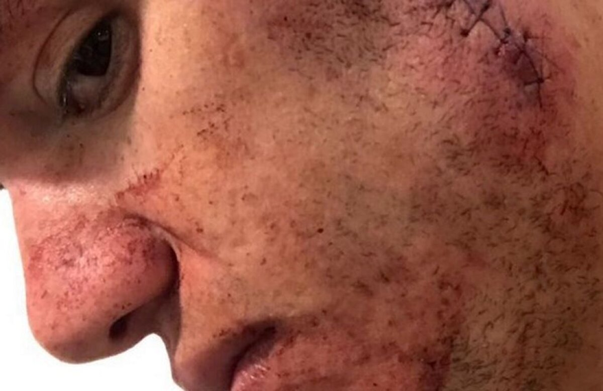 FOTO Cum arăta faţa lui Ederson la câteva minute după ce a fost tăiat de crampoanele lui Mane