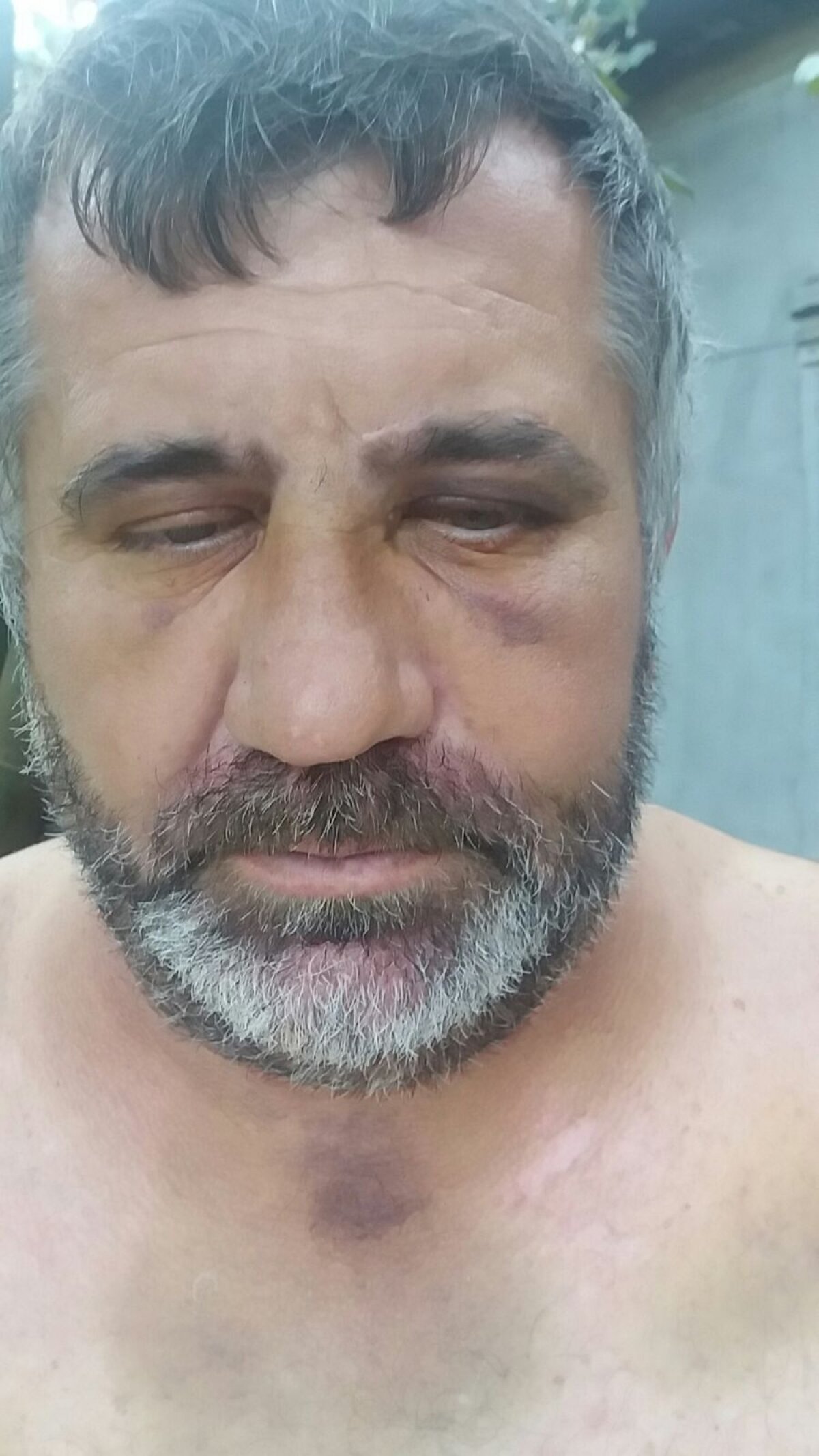 FOTO EXCLUSIV Cum arată antrenorul bătut de 8 persoane la un meci din Giurgiu: "Nu se poate bărbieri, e vânăt tot de la piept în sus"