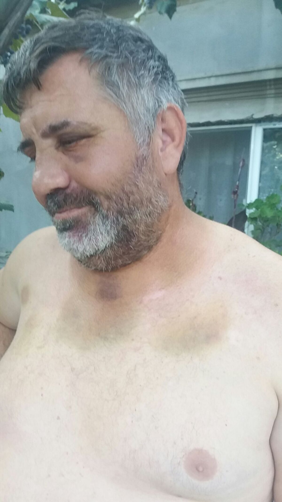 FOTO EXCLUSIV Cum arată antrenorul bătut de 8 persoane la un meci din Giurgiu: "Nu se poate bărbieri, e vânăt tot de la piept în sus"