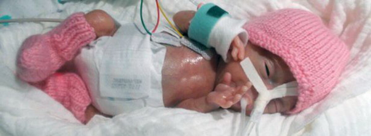GALERIE FOTO & VIDEO S-a născut cu o greutate de 229 de grame. Ce s-a întâmplat cu fetița este impresionant!