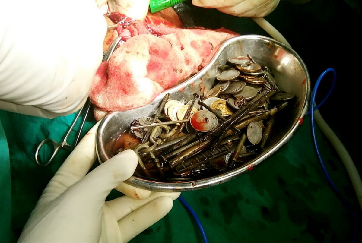 FOTO Medicii au fost şocaţi când au văzut ce are în stomac un bărbat din India!