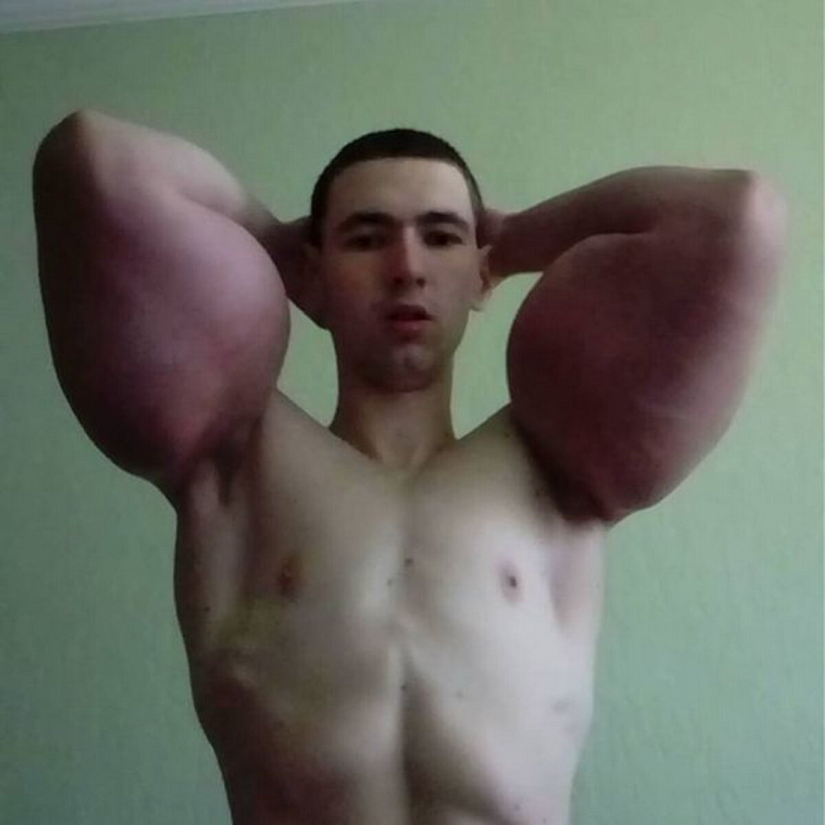 Imagini horror! Iată ce a pățit un rus care a vrut să aibă mușchi peste noapte!