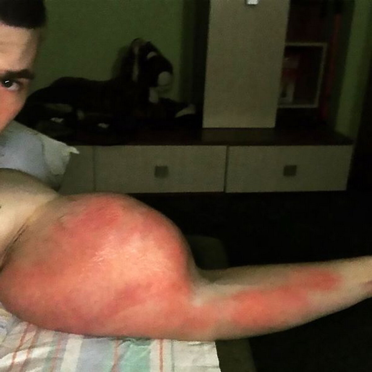 Imagini horror! Iată ce a pățit un rus care a vrut să aibă mușchi peste noapte!