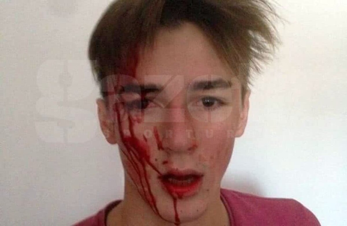 EXCLUSIV Imagine ȘOCANTĂ! Desfigurat de antrenorul de la lotul național: "M-a luat la pumni și m-a dat cu capul de masă până m-a umplut de sânge!"