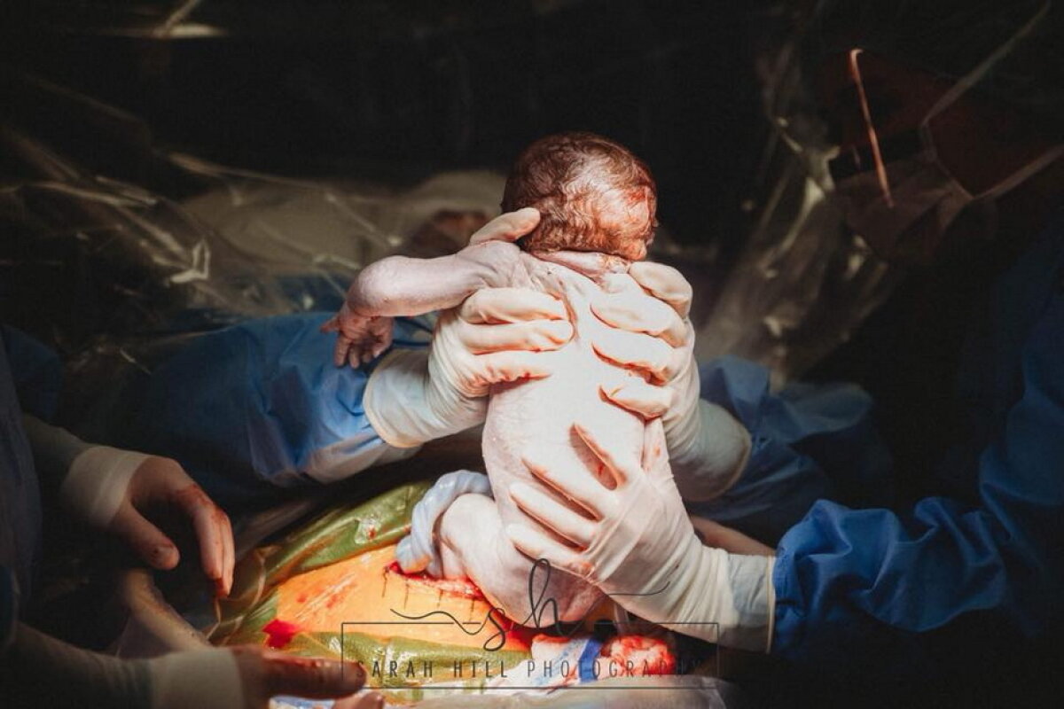 GALERIE FOTO O femeie și-a scos singură copilul din pântece, în timpul operației de cezariană