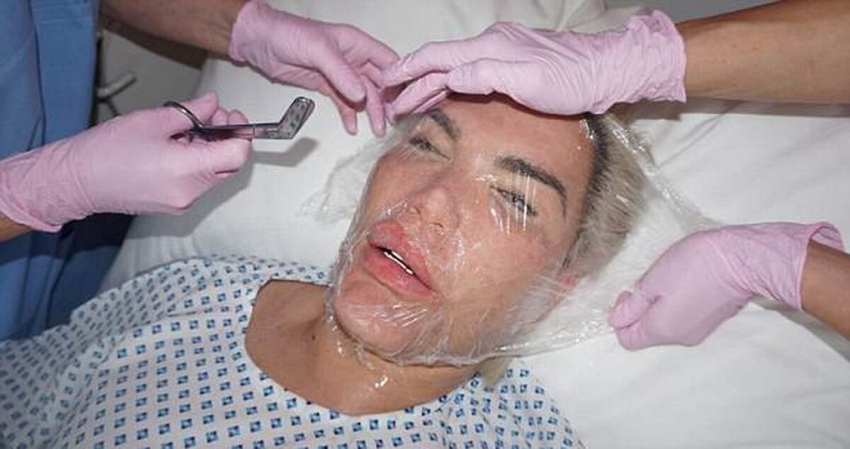 GALERIE FOTO Ultima nebunie a păpuşii umane Ken: Şi-a injectat celule stem în faţă!