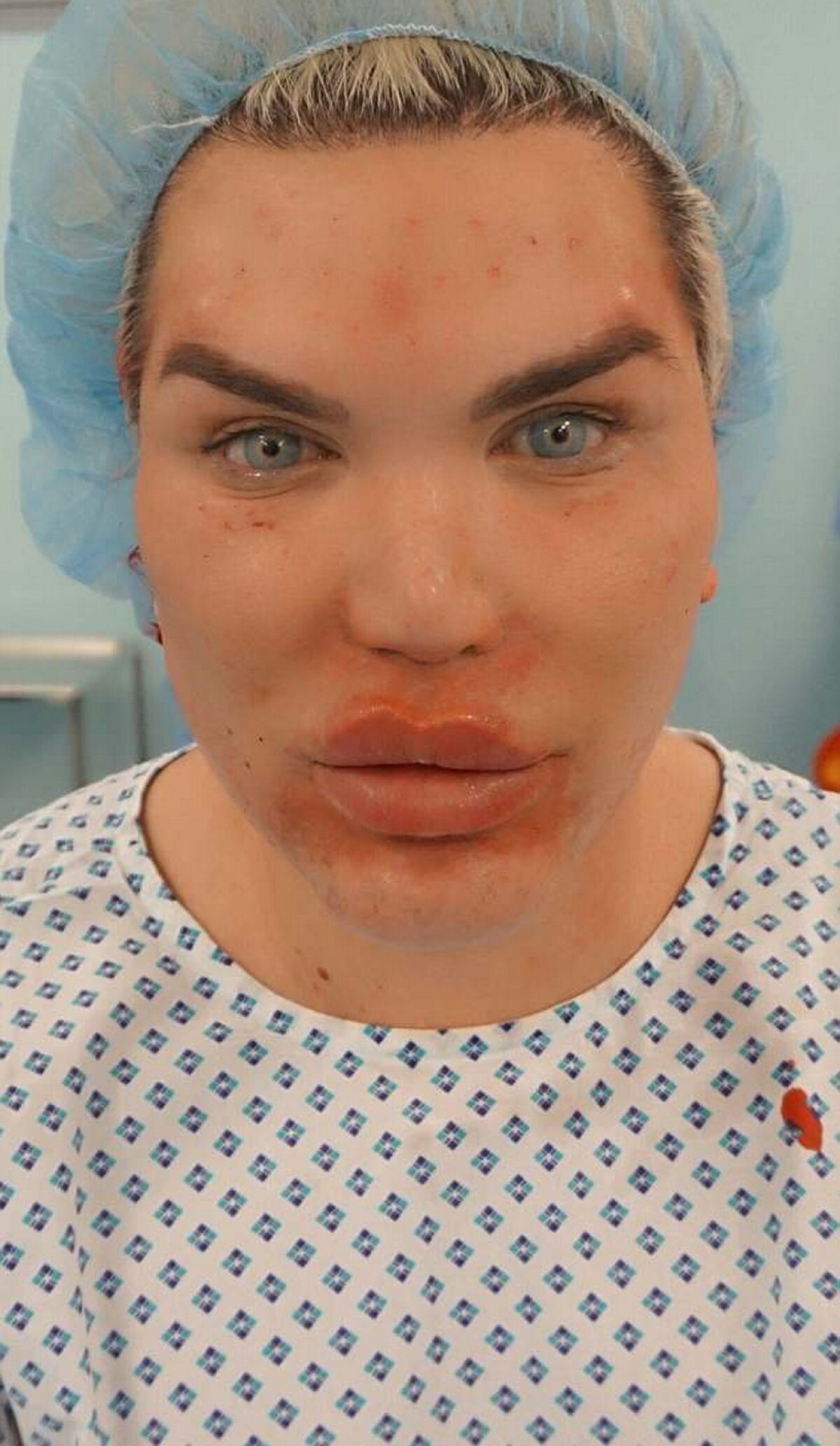 GALERIE FOTO Ultima nebunie a păpuşii umane Ken: Şi-a injectat celule stem în faţă!
