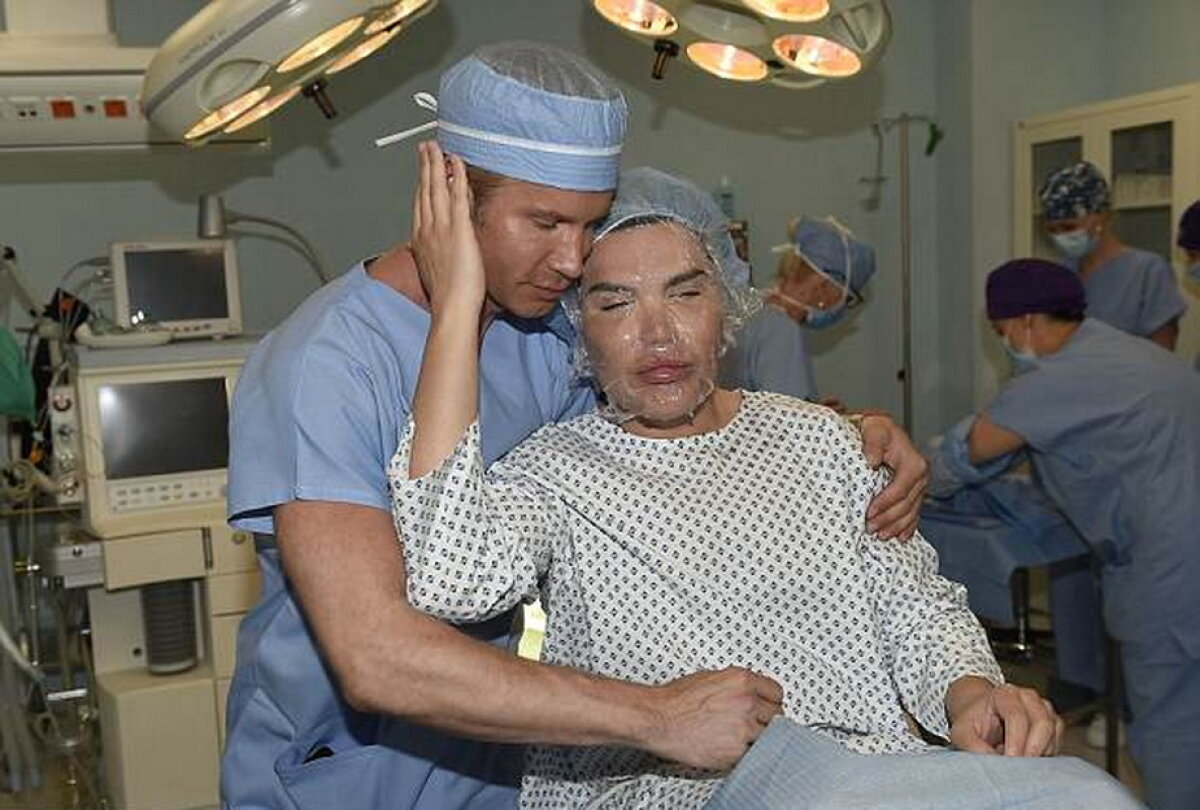 GALERIE FOTO Ultima nebunie a păpuşii umane Ken: Şi-a injectat celule stem în faţă!