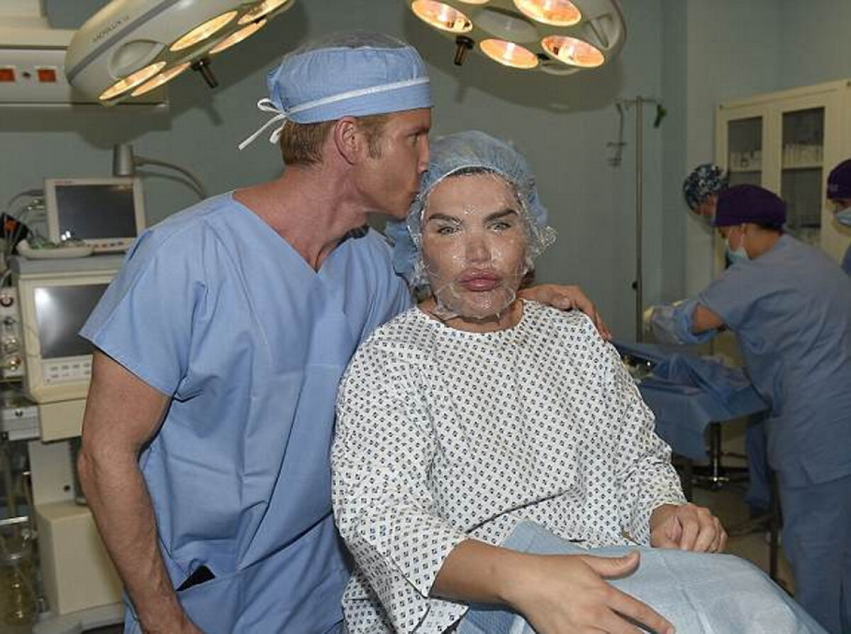 GALERIE FOTO Ultima nebunie a păpuşii umane Ken: Şi-a injectat celule stem în faţă!