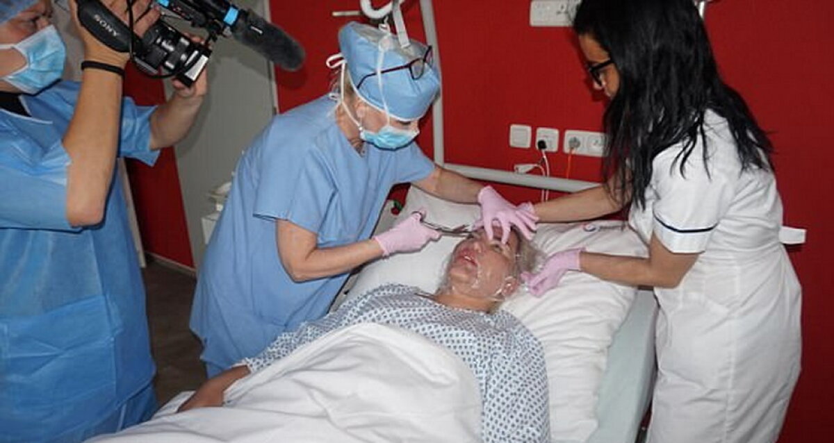 GALERIE FOTO Ultima nebunie a păpuşii umane Ken: Şi-a injectat celule stem în faţă!