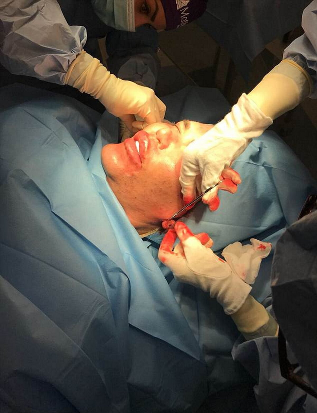 GALERIE FOTO Ultima nebunie a păpuşii umane Ken: Şi-a injectat celule stem în faţă!
