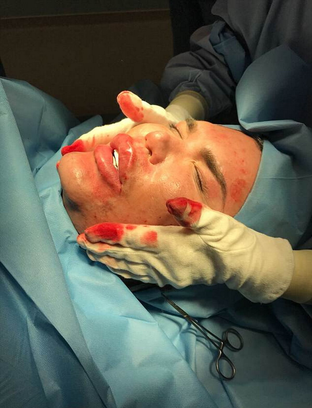 GALERIE FOTO Ultima nebunie a păpuşii umane Ken: Şi-a injectat celule stem în faţă!