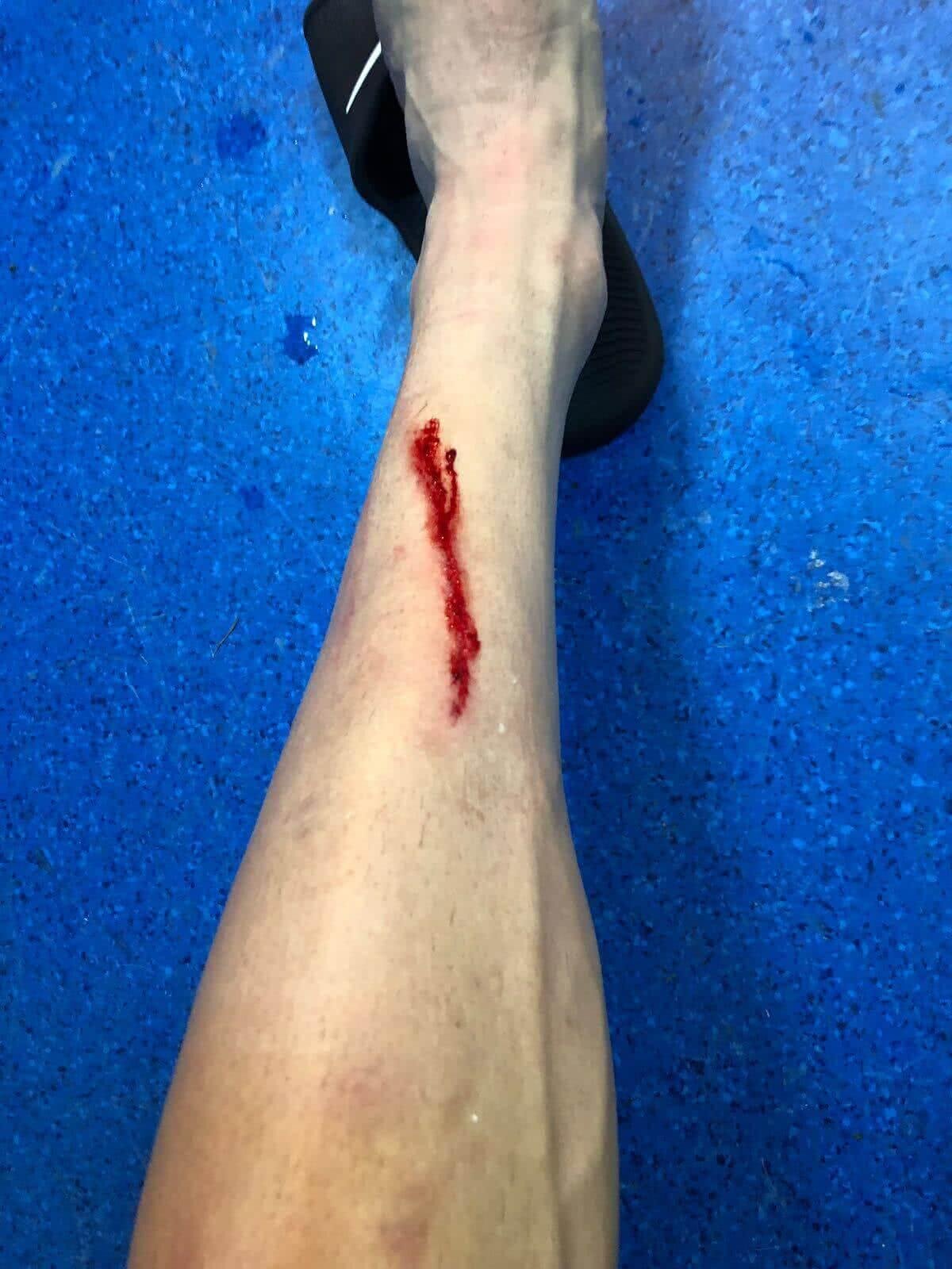 FOTO Cum arată piciorul lui Ianis după intrarea criminală a lui Mihăescu! Ce s-a întâmplat după meci, la vestiare