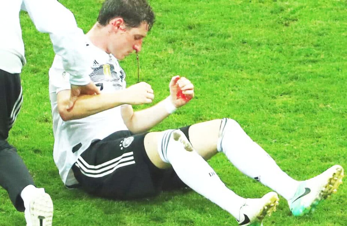 GALERIE FOTO Accidentare șocantă în Germania - Suedia » Accidentare involuntară, hemoragie incontrolabilă și nervi pe margine