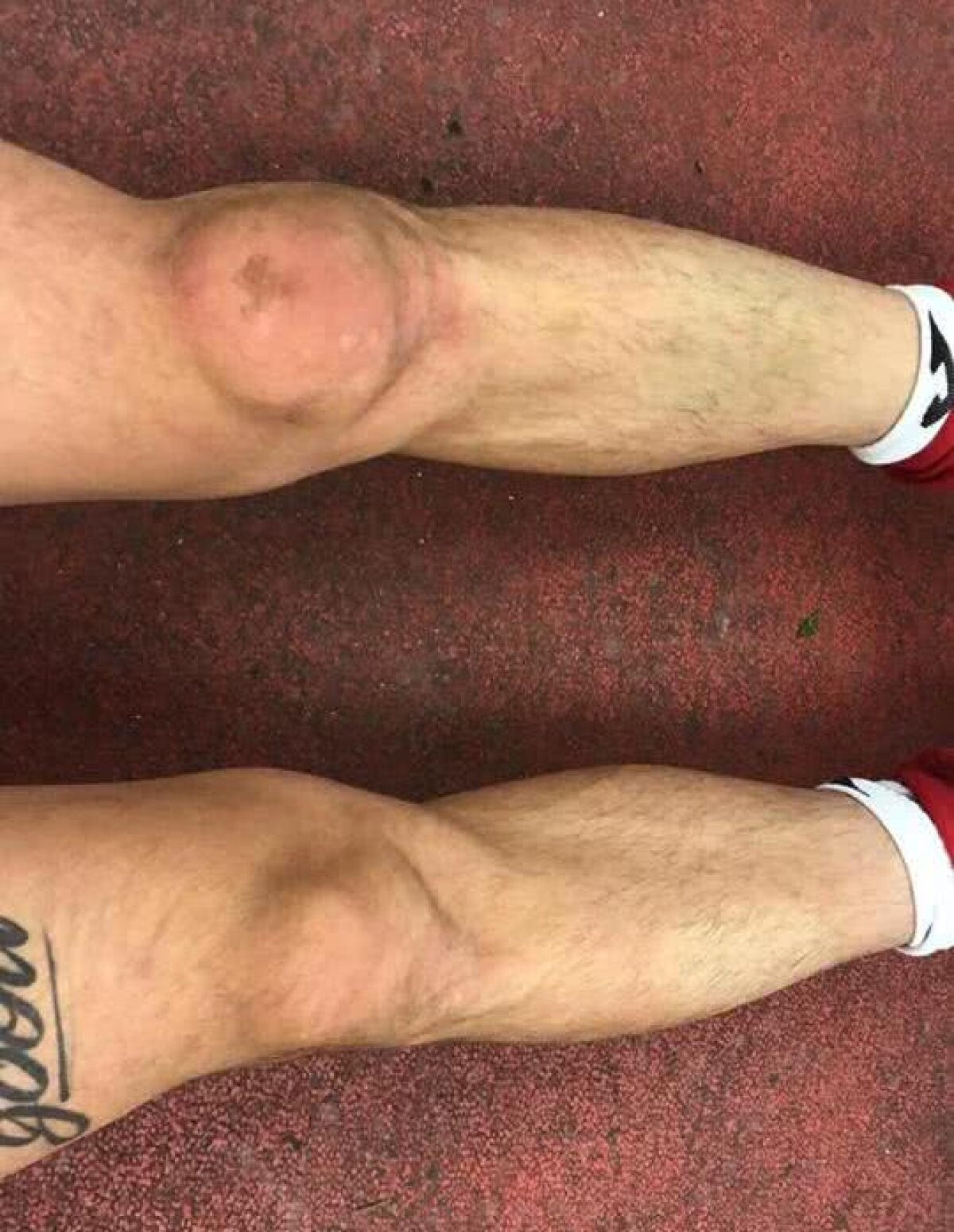 FOTO Imaginile suferinței! Cum arată picioarele lui Sergiu Hanca după meciul cu Gaz Metan