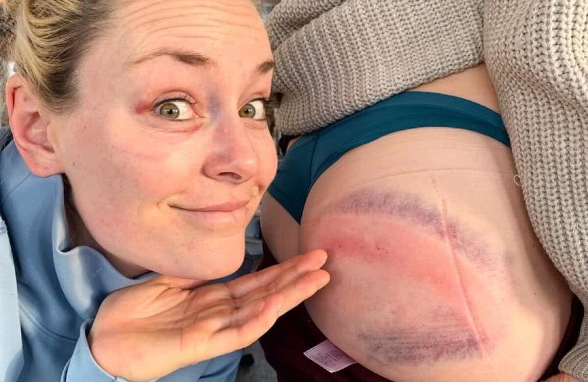 FOTO Și-au arătat vânătăile! Imagine inedită postată de Lindsey Vonn după ce a căzut de pe schiuri